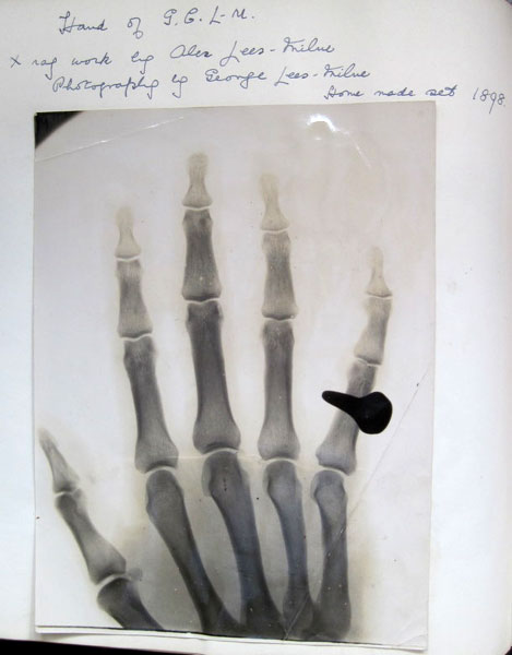 George Lees-Milne's left hand, by his brother Alec. Röntgen discovered X rays in in 1895 so this 1898 picture is a very early example.